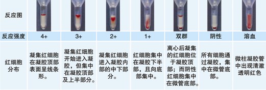 【試驗?zāi)康暮驮怼? ABO血型鑒定是通過檢測被檢者紅細胞上是否存在A和/或B抗原(正定型)以及被檢者血漿中是否存在抗A和/或抗B抗體(反定型)來確定。 對于成年個體被檢者,紅細胞上的A和/或B抗原與血漿中的抗A和/或抗B抗體存在一種對應(yīng)關(guān)系。其獨特性質(zhì)在于:紅細胞上缺乏A和/或B抗原,則血清中存在與所缺乏的抗原對應(yīng)的強反應(yīng)性抗體,如紅細胞上缺乏A抗原,則可以預(yù)見血漿中存在抗A抗體。 常規(guī)的ABO定型必須包括正定型(紅細胞定型)和反定型(血漿定型),并將正反定型結(jié)果相互驗證,只有正反定型結(jié)果一致時才能準確定型。 Rh陽性和Rh陰性的鑒定是通過檢測被檢者的紅細胞上是否有D抗原,有D抗原為Rh陽性,沒有D抗原則為Rh陰性。 ABO/RhD血型定型檢測試劑卡采用凝膠作為微柱凝膠卡的填充物,將生物化學(xué)的凝膠分子篩過濾技術(shù)、離心技術(shù)和血型血清學(xué)的抗體特異性結(jié)合在一起,其中 抗A凝膠管中灌注了含抗A抗體的凝膠,抗B凝膠管中灌注了含抗B抗體的凝膠,抗D凝膠管中灌注了含IgM抗D抗體的凝膠。A細胞、B細胞及Ctl管中灌注 了不含血型抗體的凝膠,抗A、抗B及抗D凝膠管用于紅細胞上A、B及D抗原檢測,而A細胞、B細胞用于檢測血漿中的抗體,Ctl管用于自身對照。當(dāng)抗原抗 體反應(yīng)時,凝集的紅細胞在離心力的作用下不能通過凝膠而留在凝膠上層或游離在凝膠中,呈現(xiàn)陽性反應(yīng);而抗原抗體沒有反應(yīng)時,未凝集的紅細胞在離心力的作用 下可通過凝膠而沉積在微柱凝膠管的底部,呈現(xiàn)陰性反應(yīng)。 20121212104122758.jpg 【ABO/RhD血型定型檢測試劑卡的用途】 1.?用于輸血前檢測 (1) 鑒定ABO血型,以備選擇ABO血型相配合的血液用于交叉配血。 (2) 鑒定RhD血型,以備選擇RhD血型相配合的血液用于交叉配血。 2.?用于圍產(chǎn)期檢查 (1)?用于產(chǎn)前夫婦的ABO、RhD血型檢測,進行新生兒溶血病產(chǎn)前預(yù)測。 (2)?用于產(chǎn)后母子的ABO、RhD血型檢測,進行新生兒溶血病產(chǎn)后診斷。 3.?用于常規(guī)ABO、RhD血型化驗檢查,如健康體檢等。 【樣本要求】 1.?建議使用抗凝的血樣,尤其是EDTA抗凝管采集的血樣,需要量2ml 。(EDTA抗凝采血管為紫帽管)。 2.?血液樣本在采集后48小時以內(nèi)檢測。 【所需儀器設(shè)備及耗材】 1.?ABO、RhD血型定型檢測試劑卡 2.?血型血清學(xué)離心機(用于離心分離血漿、洗滌紅細胞) 3.?微柱凝膠卡離心機 4.?微量移液槍及吸頭 【試驗操作】? 按照下列步驟進行操作 一、被檢血液樣本的處理及反定型A型、B型紅細胞的準備 1.?EDTA抗凝的血液樣本離心3000rpm 1分鐘,將上清血漿轉(zhuǎn)入一支12×75mm 試管中,余下的壓積紅細胞備用。如果血漿有不溶物(如混入的紅細胞)或不澄清透明,則需要將血漿再次離心,直到澄清透明不含不溶物為止。 2.?另取一支12×75mm試管中,加入0.1ml上述步驟1中的壓積紅細胞 ,用生理鹽水洗滌一次,棄上清,得到壓積紅細胞。 3.?在一支12×75mm試管中,加入1ml生理鹽水(或LISS液),加入步驟2中得到的壓積紅細胞10μl,混勻得到0.8~1%的被檢紅細胞懸液。 4.?將反定型A型、B型紅細胞用生理鹽水或LISS液配制成0.8~1%濃度。 二、ABO、RhD定型 1.?取ABO/RhD血型定型檢測試劑卡一片,注意檢查外觀,確保凝膠管的凝膠上層存在液面,凝膠不會干涸。將符合要求的卡進行標(biāo)記,按照試驗需要撕開封口膜。 2.?用微量移液槍分別向抗A、抗B、抗D孔及Ctl孔的每孔樣品槽中沿樣品槽內(nèi)壁呈45°角緩慢加入50μl 0.8~1%濃度的被檢者紅細胞懸液。 3.?向A細胞孔中加入50μl?0.8~1%的A型紅細胞懸液。 4.?向B細胞孔中加入50μl?0.8~1%的B型紅細胞懸液。 5.?分別向A細胞、B細胞、Ctl孔中加入25μl 被檢者血漿。 6.?在臺面交替輕扣卡左下角和右下角,確保所加入的液體在卡的樣品槽中呈水平狀態(tài),而不是偏向一側(cè)。 7.?將卡放入微柱凝膠卡離心機離心,LB-3000低速離心機第一檔離心900rpm 2分鐘,再1500rpm 3分鐘,判讀結(jié)果并記錄。 【結(jié)果判讀及解釋】 1.?反應(yīng)陰、陽性的判讀 20121212104153407.jpg 【注意事項】 1. 建議在使用凝膠卡前先離心再應(yīng)用。 2. 若凝膠卡封口開裂、孔中凝膠干涸或有氣泡,不可使用。 3. 撕開凝膠卡封口膜時,不能用力過猛,以免造成凝膠微孔間的交叉污染。 4. 樣本采集后應(yīng)盡快檢測,若試驗需要延遲,應(yīng)將樣本置2~8℃下短期儲存。 5. 紅細胞懸液的濃度為0.8~1%,濃度過高或過低會影響檢測結(jié)果。 6. 溶血、脂血、細菌污染等情況的標(biāo)本會影響檢測結(jié)果。 7. 血漿或血清標(biāo)本須充分離心去除纖維蛋白,否則會阻止紅細胞在微柱凝膠中的沉降,出現(xiàn)假陽性。 8. 人源血液樣本存在潛在的傳染性,凝膠卡使用后按醫(yī)療生物垃圾處理。 9. 在Ctl孔(自身陰性對照)結(jié)果為陽性時,試驗結(jié)果無效。可能原因是由于被檢紅細胞已經(jīng)致敏IgM抗體導(dǎo)致自發(fā)凝集,此時可以用DTT將已經(jīng)致敏到紅細胞上的IgM抗體破壞后再行 ABO、RhD血型檢測。 10. 抗D凝膠不能鑒定弱D、部分D(如DⅥ)抗原。對于患者,如果抗D凝膠管中患者的紅細胞反應(yīng)為陰性,則確定為RhD陰性。 11. 若出現(xiàn)<2+的弱陽性反應(yīng),須做進一步試驗才能準確定型,即確認弱反應(yīng)是由于被檢者的抗原減弱還是凝膠微孔之間的交叉污染引起。 12. 若出現(xiàn)混合視野反應(yīng),需要了解被檢者近期3個月內(nèi)是否有輸血史,或被檢者是否為骨髓移植患者。 13. 由于6月齡以下的嬰兒其血漿/血清中不似成人一樣存在可預(yù)見的抗A/抗B抗體,因此只做正定型不做反定型。 【ABO正反定型不一致原因分析】 如果血型定型正反定型結(jié)果不一致時,則不能準確定型,需要分析產(chǎn)生不一致的原因。 引起正反定型不一致的原因如下: (一)正定型出現(xiàn)弱反應(yīng)或缺失抗原 1. A亞型、B亞型或AB亞型。 2. 白血病導(dǎo)致A或B抗原減弱。 3. 何杰金病(Hodgkin’s)有時會抑制抗原表達,與白血病類似。 4. 由于某種疾病(如腹腔癌、胰腺癌)導(dǎo)致血漿中存在大量的血型物質(zhì),中和抗A或抗B抗體,引起正定型為假陰性或弱陽性。 需要將正定型的紅細胞用生理鹽水洗滌后再次定型可解決此問題。 5. 骨髓移植。 6. 非ABO同型輸血。 (二)正定型紅細胞上多余的抗原反應(yīng) 1. 自身凝集紅細胞、抗體致敏紅細胞導(dǎo)致。 2. 細胞未洗滌,血漿蛋白引起的假陽性反應(yīng)。 3. 細胞未洗滌,血漿中存在針對正定型試劑中某種成分的抗體導(dǎo)致。 4. 骨髓移植。 5. 獲得性B。 6. B(A)現(xiàn)象。? 7. ABO非相合輸注。? (三)正定型出現(xiàn)混合視野反應(yīng)? 1. 近期輸血。? 2. 骨髓移植。? 3. 異卵雙胞胎或雙受精卵產(chǎn)生的嵌合體。? 4. 胎兒和母體出血。? (四)反定型血清中出現(xiàn)弱反應(yīng)或反應(yīng)缺失? 1. 年齡相關(guān):新生兒以及小于6月齡的嬰兒以及老年人。? 2. ABO亞型有亞型抗體,如A2、A2B型人的抗A1。? 3. 低球蛋白血癥(如白血病人、使用免疫抑制劑患者、免疫缺陷患者)。? 4. 移植患者使用抗排異藥物。? 5. 雙胞胎或雙受精卵產(chǎn)生的嵌合體。? (五)反定型出現(xiàn)多余的抗體反應(yīng)? 1. 冷自身抗體。? 2. 特異性冷同種抗體A。? 3. 血清中存在針對試劑紅細胞保存液成分的抗體。? 4. 某些疾病導(dǎo)致球蛋白水平增高(多發(fā)性骨髓瘤、巨球蛋白血癥、Hodgkin’s 淋巴瘤)引起緡錢狀凝集。 5. 輸用大分子血漿擴容劑。? 6. 非ABO同型的移植。? 7. 靜脈注射免疫球蛋白。? (六)技術(shù)方面的錯誤? 1. 血液樣本被污染,如混入其他人樣本。? 2. 被檢紅細胞的濃度過高或過低。? 3. 忘記在反應(yīng)體系中加入檢測樣本或試劑。? 4. 未按照試劑使用說明進行試驗。? 5. 離心步驟離心時間不足或離心時間超時。? 6. 對試驗結(jié)果記錄或判讀不正確。